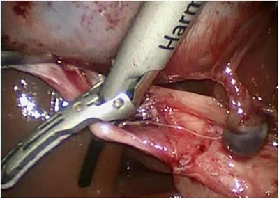 Evaluation of the safety of using harmonic scalpel during laparoscopic cholecystectomy in children: A preliminary report